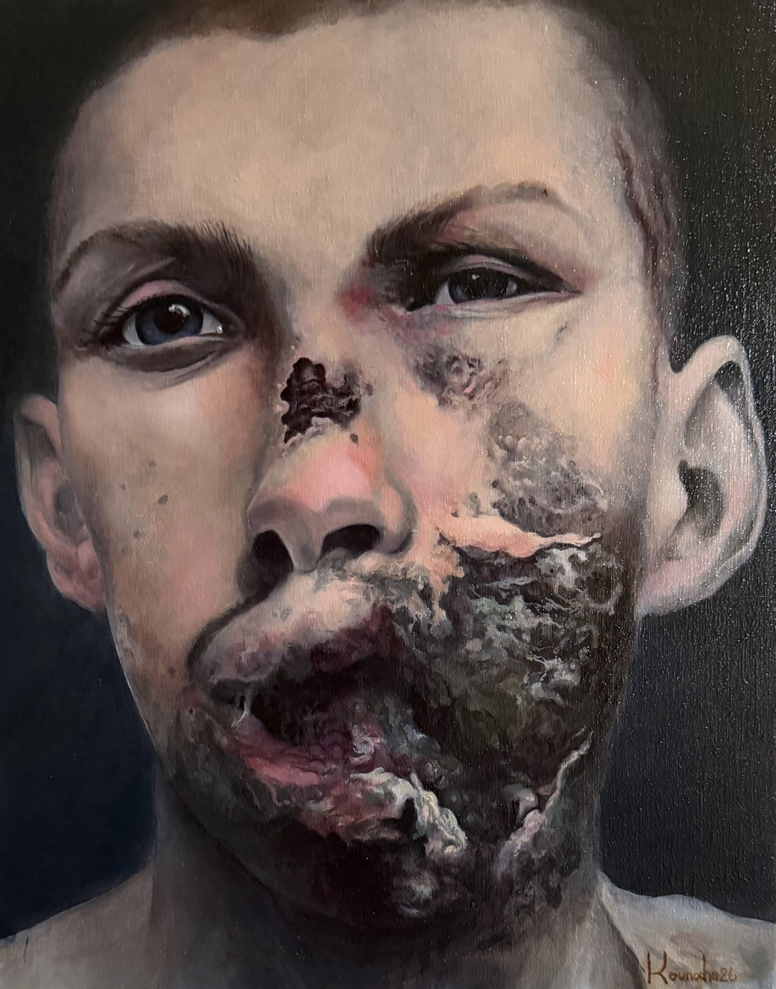 Portrait frontal : la joue et la bouche rongées, le regard soutenu.